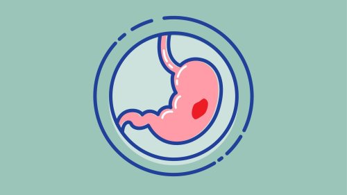 Know The Signs: Peptic ulcers