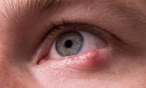 Mückenstich am Auge: Wie gefährlich ist das?