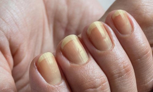 Gelbe Fingernägel: Ursachen und Tipps