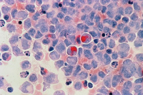 Cette nouvelle IA détecte le cancer avec une efficacité jamais vue auparavant