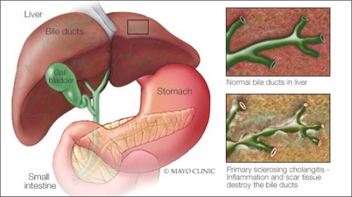 Mayo Clinic Q and A: How to manage symptoms of liver disease - Mayo Clinic News Network