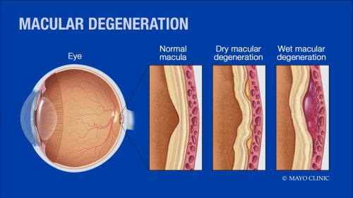Macular Degeneration Frozen Shoulder Regenerative Cartilage Repair