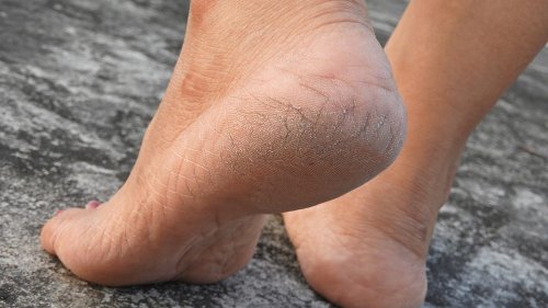 How to heal cracked heels