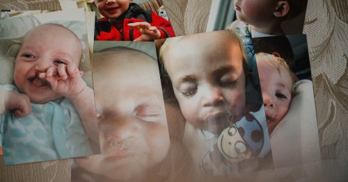 A Utah Cleft Palate Team Says Its Approach Is Innovative. Others See a Pattern of Unnecessary Surgeries on Children.