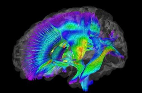 Brain mapping study links abnormal sleeping patterns to decreased white matter integrity