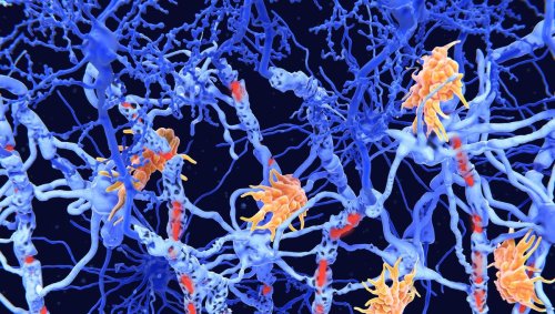 Une vaste étude démontre l'utilité de la vitamine D pour diminuer les effets de la sclérose en plaques
