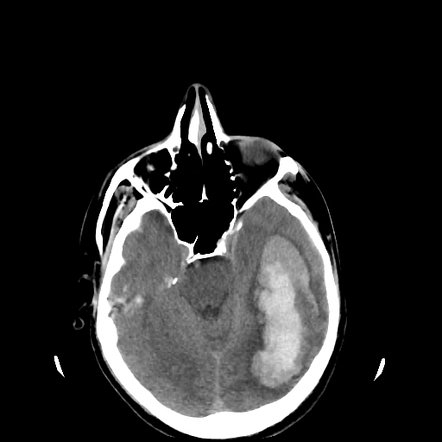 Lobar intracerebral hemorrhage | Radiology Case | Radiopaedia.org
