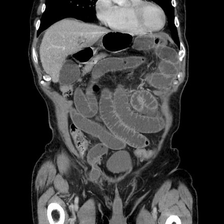 Small bowel obstruction - indirect inguinal hernia | Radiology Case | Radiopaedia.org