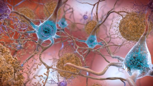 The New 'Breakthrough' Alzheimer's Drugs Might Really Be Disappointing Dead Ends