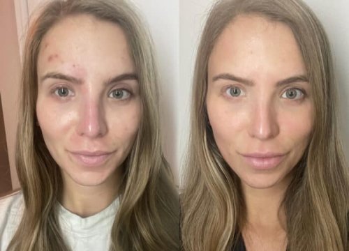 I Tried AviClear Laser to Help Clear My Hormonal Acne