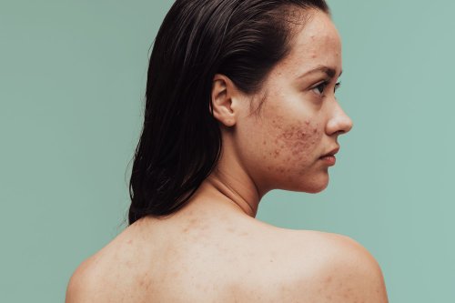3 Types of Acne Scars—and the Best Treatments for Each