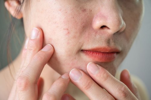 10 Best Ingredients for Acne, According to Dermatologists