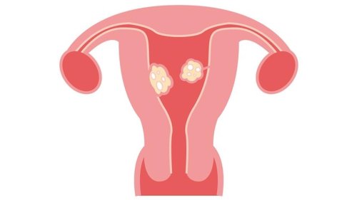 Le conseil santé - Comment repérer, diagnostiquer et traiter les fibromes utérins ?