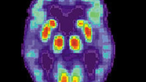 Invité international - Médicament anti-Alzheimer: «Cela montre qu'on est sur la bonne voie en recherche fondamentale»