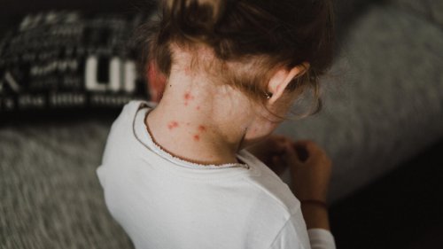Le conseil santé - Quelles sont les principales séquelles de la rougeole ?