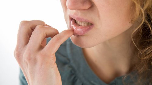 Schmerzhafte Aphthen: Wie wird man Entzündungen im Mund wieder los?