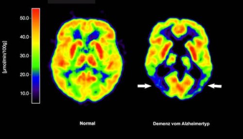 Alzheimer-Therapie: EU-Kommission lässt Wirkstoff Lecanemab zu