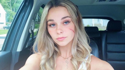 We Met TikTok's 'Scar Girl' in Person. The Official Ruling? She Doesn't Owe You Sh-t
