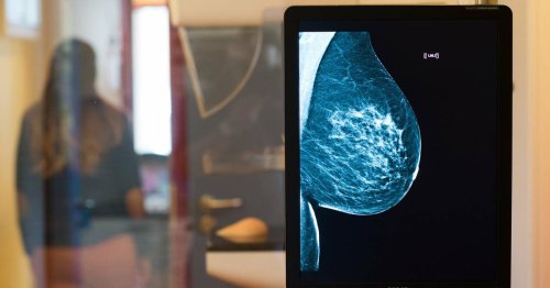 Krebsfrüherkennung: Wem nützt die Mammografie?