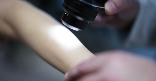 Krebs-Screening: Hautärzte-Verband fordert staatlich organisierte Vorsorge