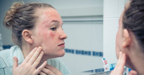 Cork GP shares the biggest at-home trigger for eczema flare ups