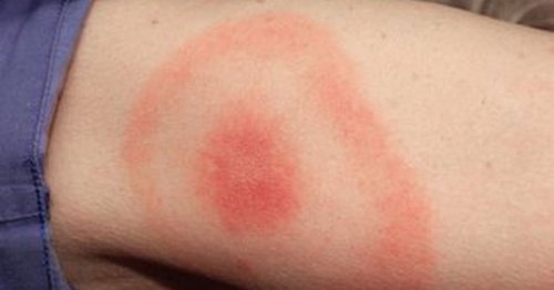 Galway doctor issues warning over ticks carrying Lyme disease in Ireland