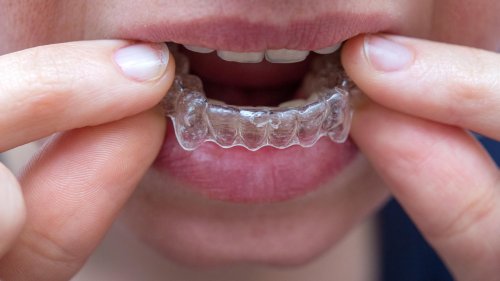 RTL-Reporterin undercover: Wie gefährlich sind Zahnschienen von DrSmile?