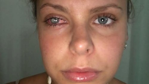Kontaktlinsen in schmutziger Kosmetiktasche: Laura (24) erblindet fast