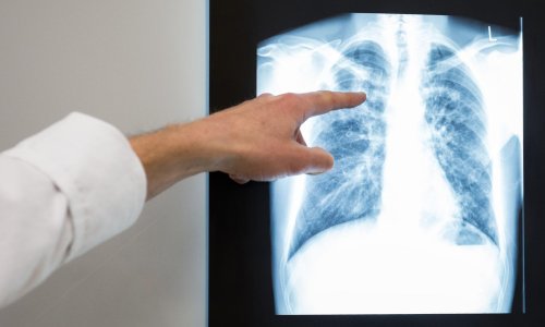 Etwas mehr Tuberkuloseerkrankungen 2022 in Bayern