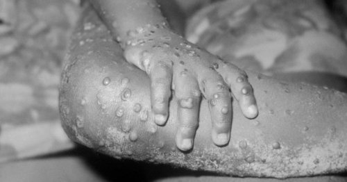 The symptoms and causes of monkeypox infections, which CDC calls an 'emerging issue'