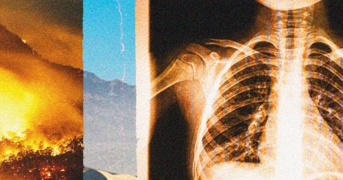 California could face another record-breaking year of Valley fever fungal infection