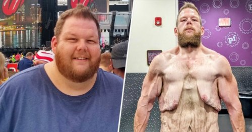 After losing 360 pounds on his own, man seeks help for extreme loose skin