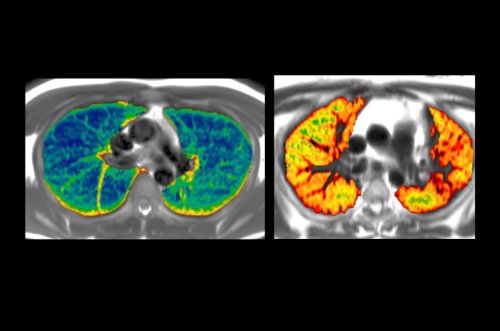 Months after hospitalization for COVID-19, MRIs reveal multiorgan damage