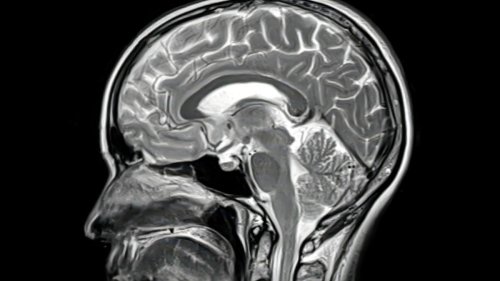 Rare Autopsy Finds Alzheimer's Drugs Only Work in Some Parts of The Brain