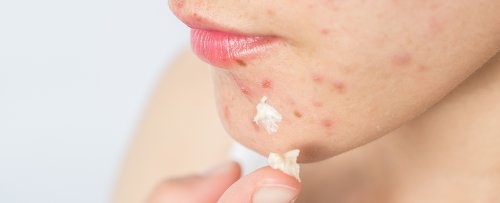 Scientists Say Powerful New Molecule Could Be a Game-Changer For Acne
