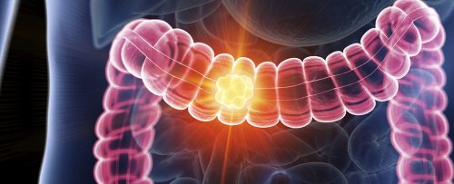 One Cancer Is Rising Rapidly in Younger People, And Bacteria Could Be Why