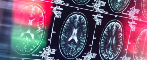 Alzheimer's Might Not Actually Be a Brain Disease, Expert Reveals