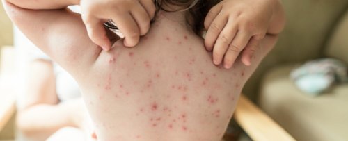 Half of All Suspected Chickenpox Cases in The US Could Be Something Else Entirely