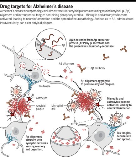 Treatments for Alzheimer's disease emerge