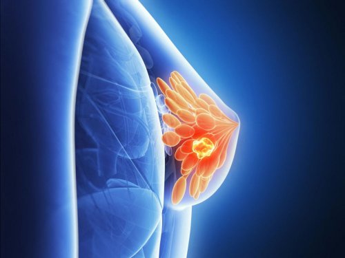 Toutes les contraceptions hormonales augmentent le risque de développer un cancer du sein - Sciences et Avenir