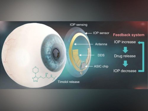Des lentilles pour traiter le glaucome - Sciences et Avenir