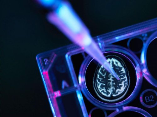 "10 % des diagnostics d'Alzheimer sont erronés"