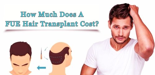 How Much Does FUE Hair Transplant Cost? – SciTech Society