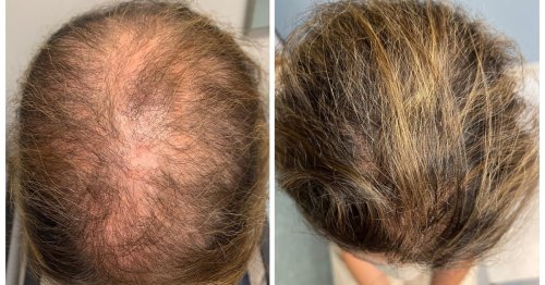 An old medicine grows new hair for pennies a day, doctors say