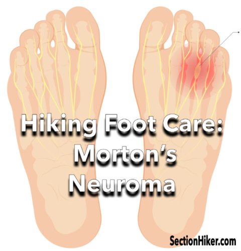 Hiking Foot Care: Morton’s Neuroma