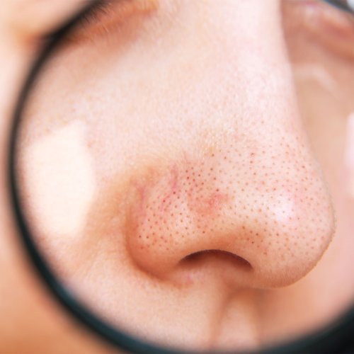 Dermatologists Say To Avoid This Mistake At All Costs When It Comes To Blackheads