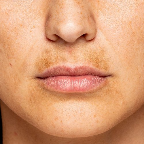 A Dermatologist Tells Us The Best Treatments For Dark Spots, Once And For All