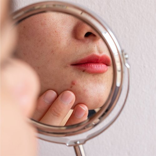 This Is The Best Way To Get Rid Of Acne Marks, According To A Dermatologist