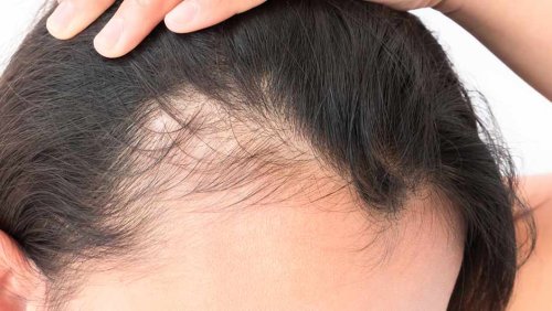 5 Cheap Natural Products Dermatologists Swear By For Hair Loss