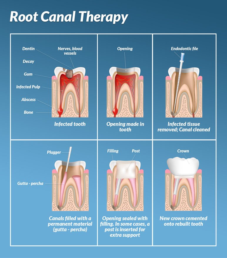 http://shelltailor0.xtgem.com/__xt_blog/__xtblog_entry/__xtblog_entry/23537225-dental-cement-is-a-fundamental-ingredient-in-your-dental-procedures?__xtblog_block_id=1#xt_blog - cover